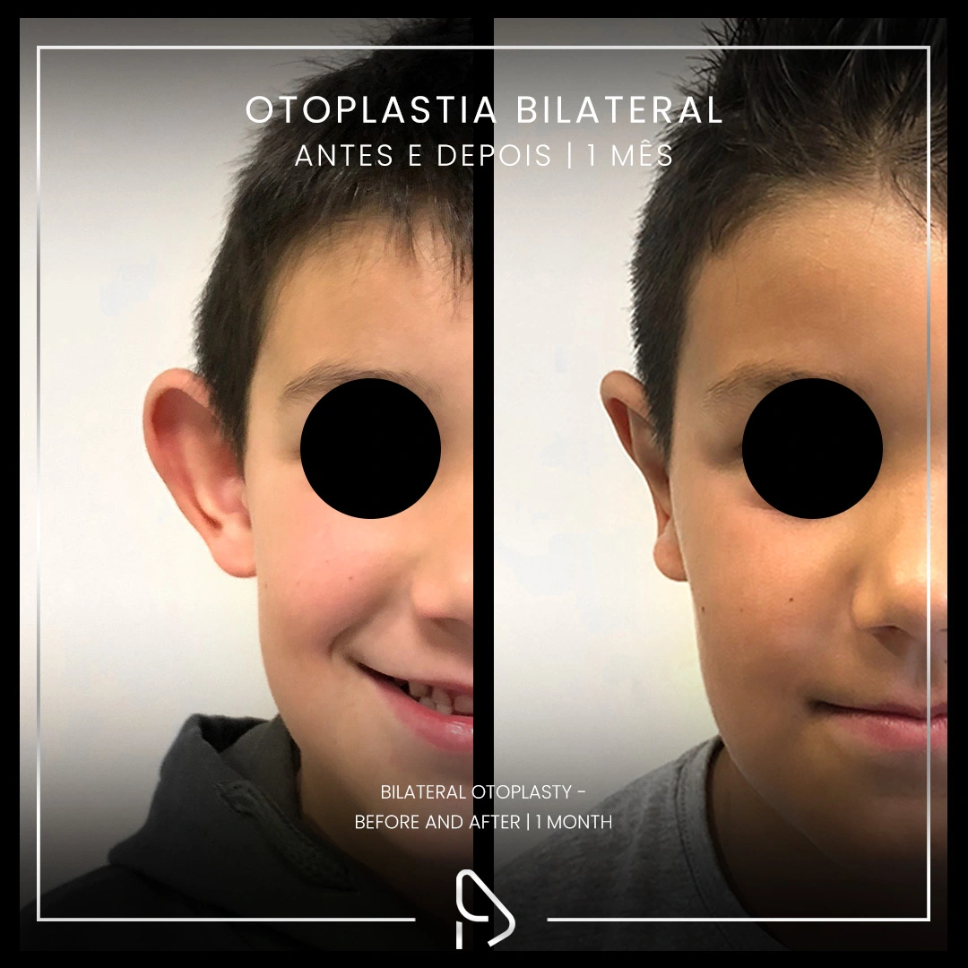 Otoplastia-caso1-1