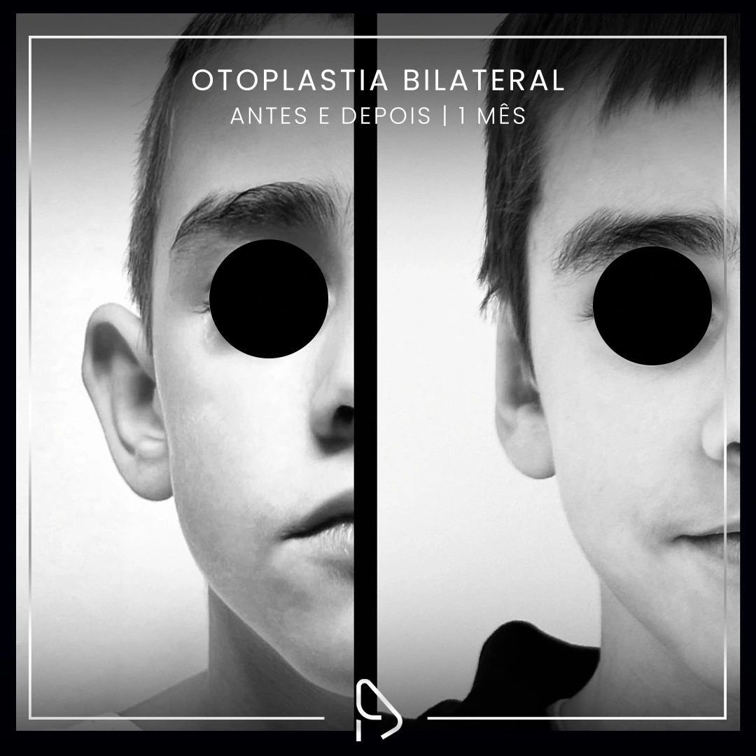 Otoplastia-caso3