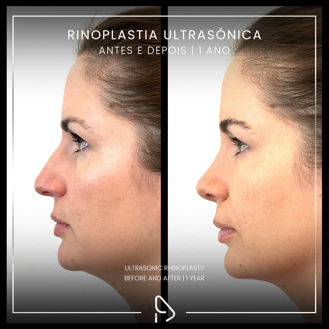Rinoplastia-caso1-1