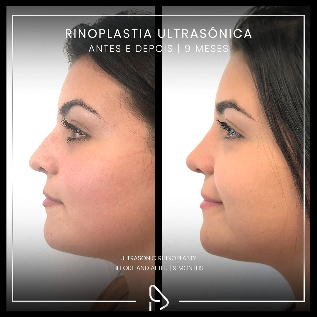 Rinoplastia-caso2-1