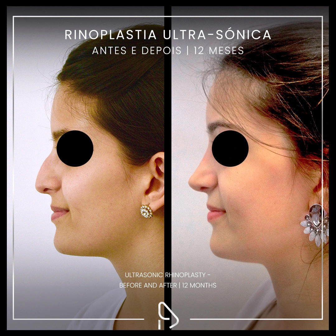 Rinoplastia-caso3